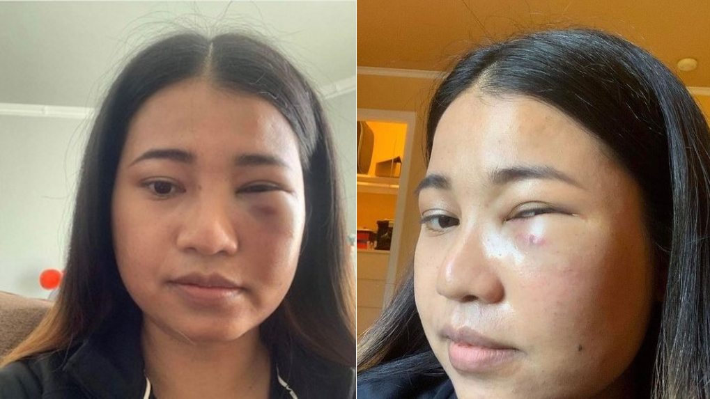 Asian Female Assaulted Aboard BART Teach In San Francisco – CBS San Francisco