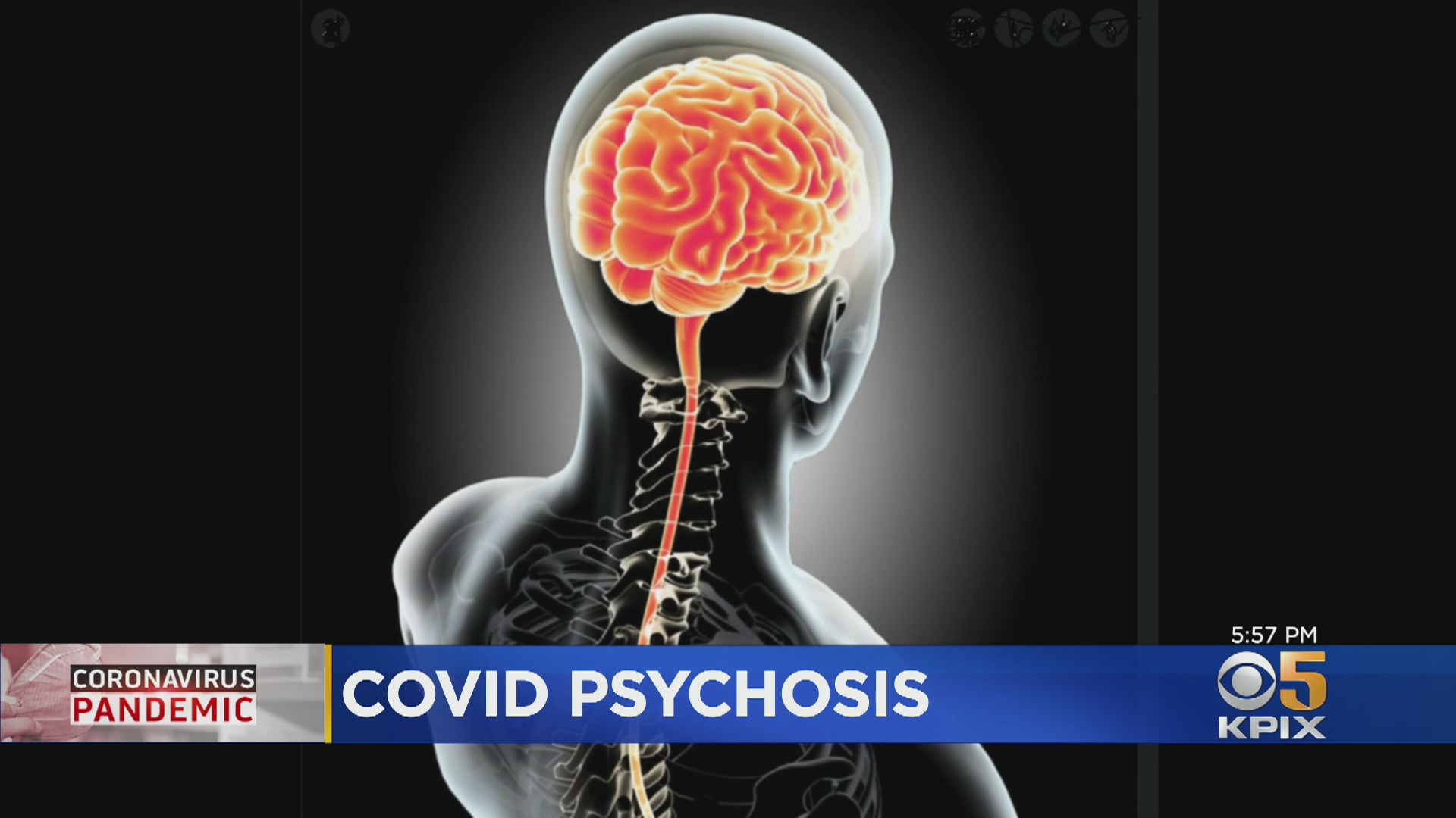 COVID: UCSF Researchers Examine Impact Of Coronavirus On Young Brains After 3 Teens Develop Psychosis - CBS San Francisco